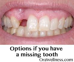 Missing Teeth What Are Your Options Orawellness