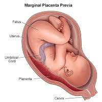 There are two different types of placenta previa: Bleeding In Pregnancy Placenta Previa Placental Abruption Children S Hospital Of Philadelphia
