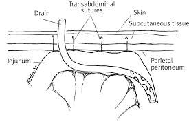 transsection through the abdominal wall