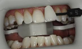 teeth whitening lead sd dentist lead