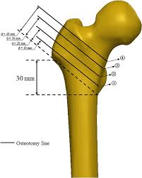 intertrochanteric fractures