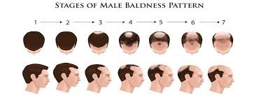 what is the hair transplant cost in