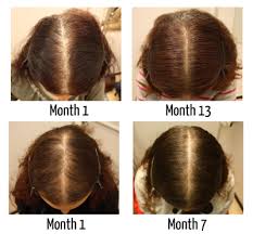 Alopecia in dogs, or hair loss, is a common disorder that causes partial or complete dog hair loss. Nigella Lawson Is Her Weight Loss Causing Hair Loss