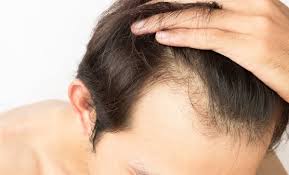 testosterone and hair loss in males