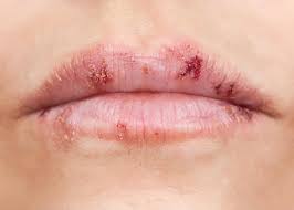 will shingles occur in the mouth