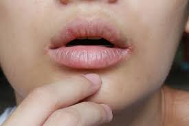 lip cheilitis dr ben cal men s