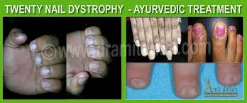twenty nail dystrophy dr amit dutta