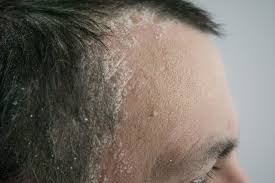 scalp psoriasis what dermatologists