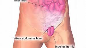 hernias after weight loss surgery are