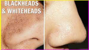 how to get rid of blackheads