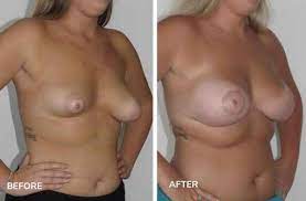 Pointy Breasts or Puffy Nipples - Tuberous Breast Correction