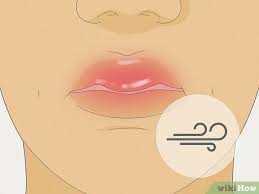 how to heal a swollen lip quickly 11
