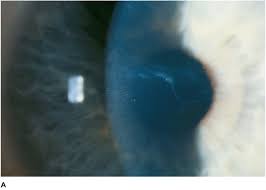 Corneal epithelial basement dystrophy is a disorder of the surface of the eye (epithelium). Corneal Dystrophies Ento Key