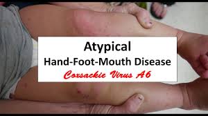 hand foot mouth disease caused by