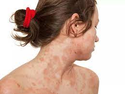 eczema flare ups itchy skin winter