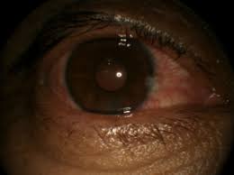 dry eye cornea roswell eye clinic