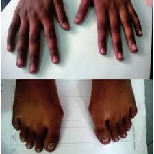 knuckle hyperpigmentation and nail