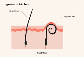 ingrown hair treatment