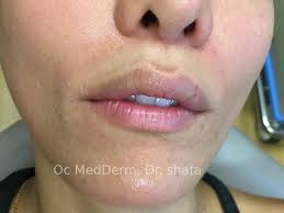 correct lips asymmetry before and