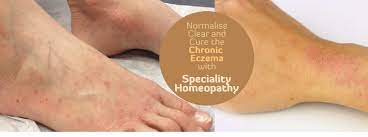atopic dermais homeopathy treatment