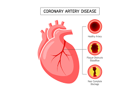 coronary artery disease cad modern