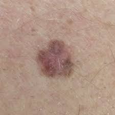The surface of the skin may break down, be itchy, tender, painful, or look scraped. Melanoma Pictures Example Pictures Of Melanoma Symptoms