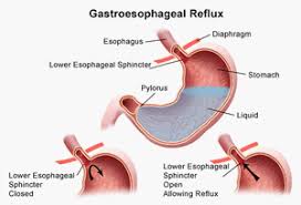 Most people can manage the discomfort of a burning pain in the chest that usually occurs after eating and may occur at night. Gastroesophageal Reflux Disease And Heartburn Choc Children S