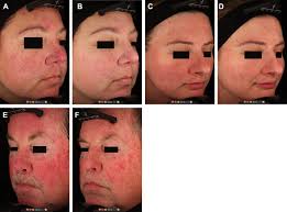 pulsed dye laser treatment of rosacea
