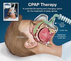 Cpac in focus view all. How To Fix Common Cpap Problems Fleetowner
