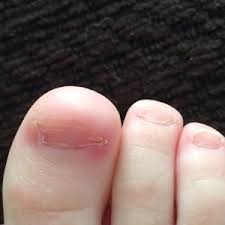 weird toenails still december 2016