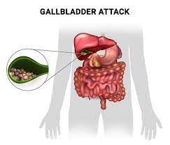 symptoms of a gallbladder