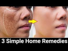 remove face pigmentation naturally