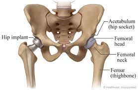 partial hip replacement video image