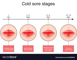 cold sore ses lips with symptoms of