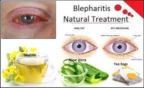blepharitis symptoms causes