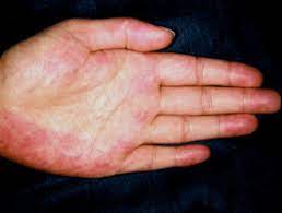 Palmar erythema is a skin condition in which the palms of both hands (and sometimes the feet) develop a reddish or darker color. Palmar Erythema Dermnet Nz