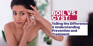 boil vs cyst telling the difference