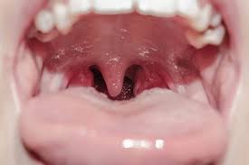ps on the back of tongue causes