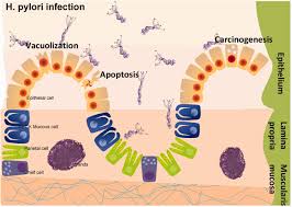 helicobacter pylori infection