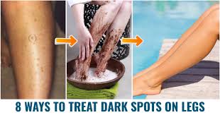 how to treat dark spots on legs