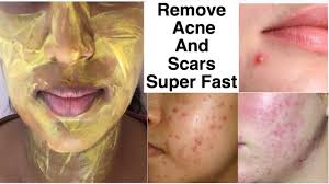 how to remove acne and acne scars super