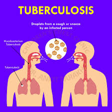 Tuberculosis (commonly abbreviated to tb, short for tubercle bacillus) encompasses an enormously wide disease spectrum affecting multiple organs and body systems predominantly caused by the. Tuberculosis Dr Ankit Parakh