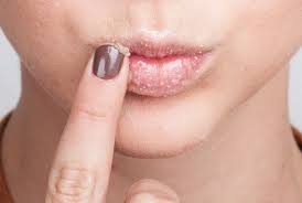 get rid of black spots on lips