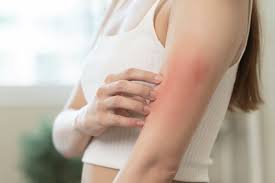 4 home remes for stress rashes