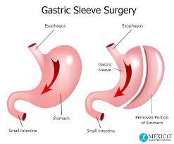 stomach after gastric sleeve surgery