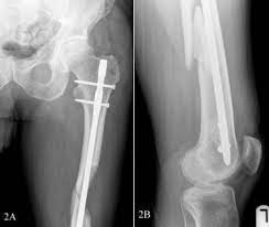 proximal femur with the intramedullary
