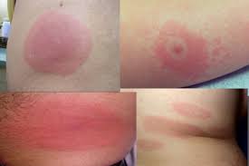 what does a lyme disease rash look like