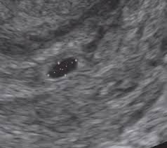 Von hebamme nadine beermann zuletzt aktualisiert in der 7. Ultraschallbilder Einer Schwangerschaft