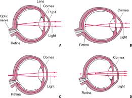 Overview Of Refractive Error Eye Disorders Msd Manual