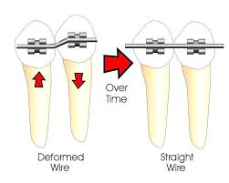 How Do Braces Work Ask An Orthodontist Com